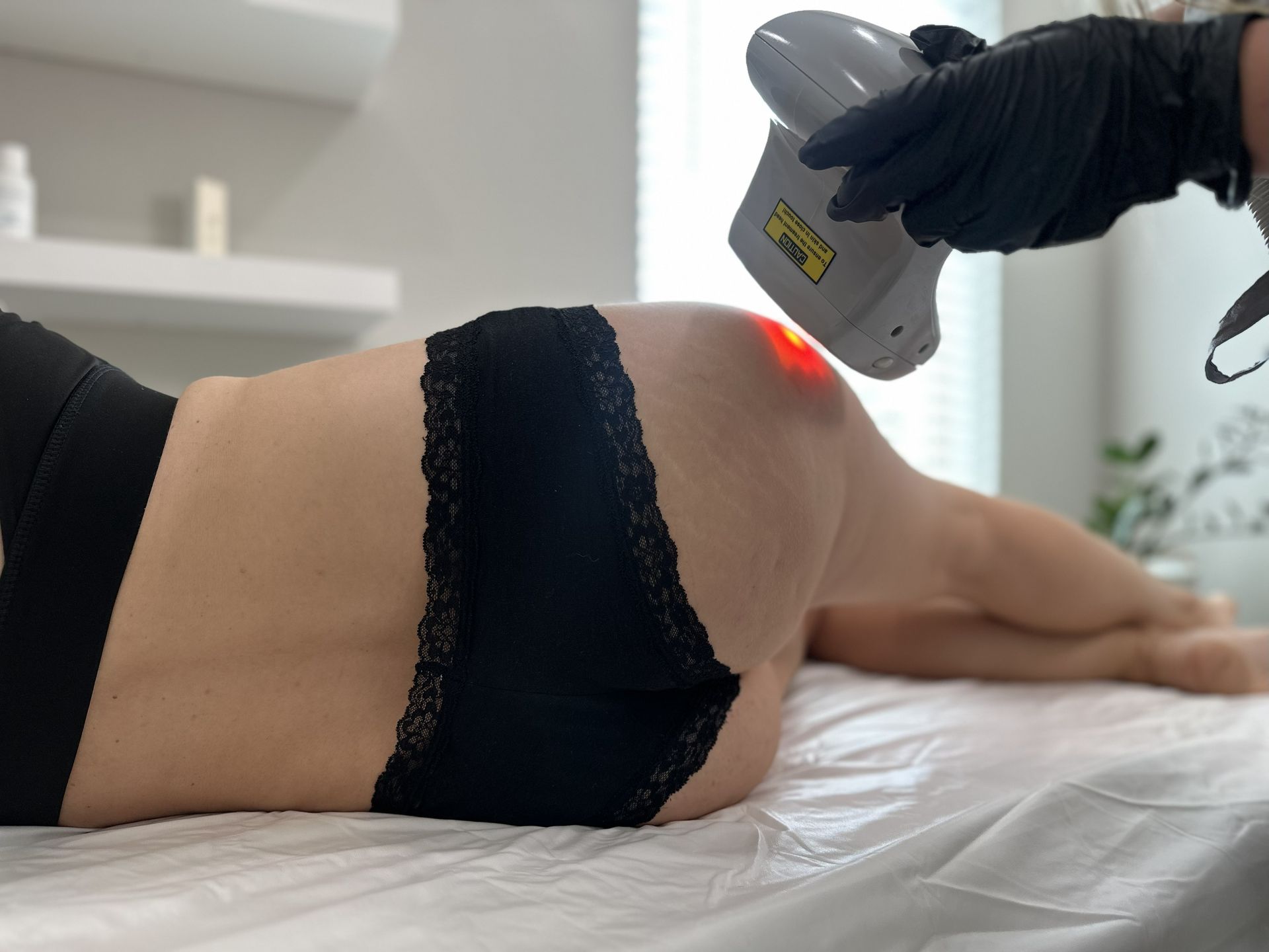 Woman receiving laser treatment on her buttock, laying on a table. Someone in a black glove holds a laser device.