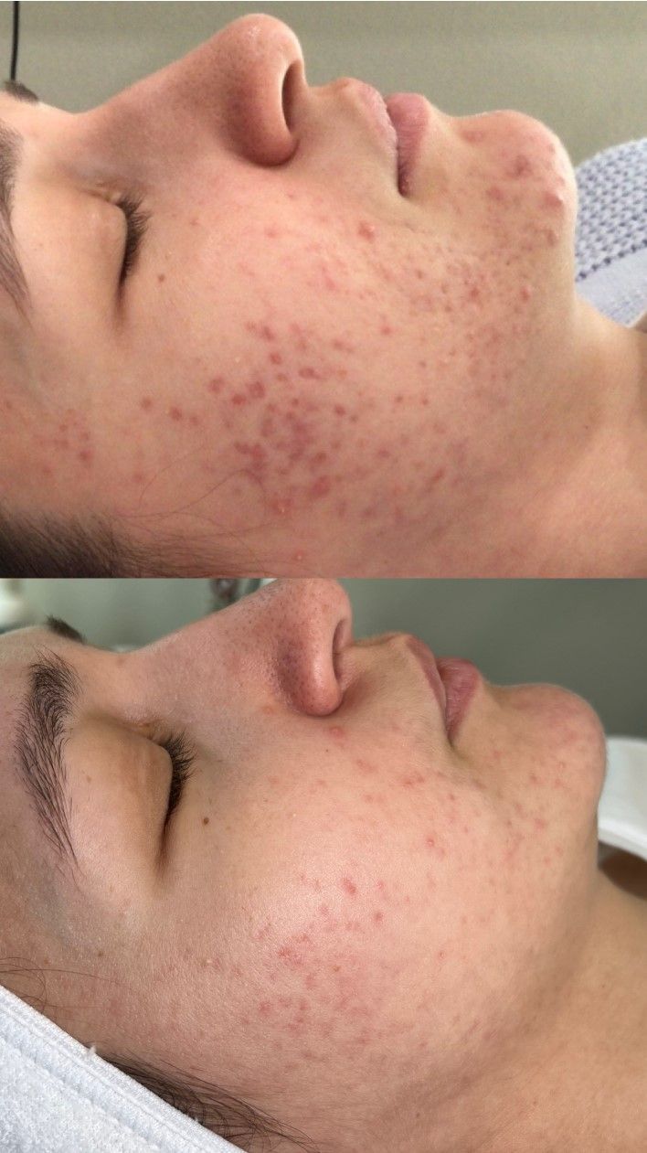 Two side-by-side photos of a person's face. Top: skin with acne. Bottom: skin with less acne.