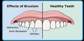Comparison of teeth affected by bruxism (left) and healthy teeth (right), showing attrition, gum recession, and abfraction.