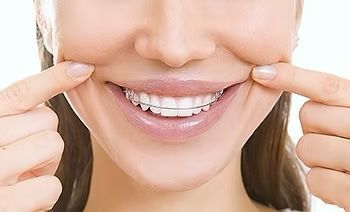 Comparison of teeth affected by bruxism (left) and healthy teeth (right), showing attrition, gum recession, and abfraction.
