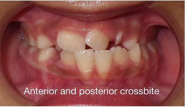 Child's mouth with anterior and posterior crossbite, visible teeth and gums.