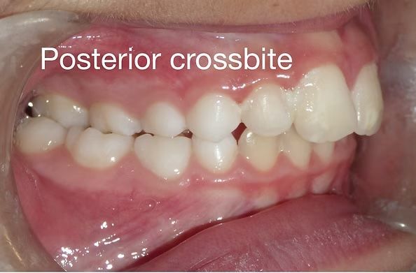 Side view of teeth with a posterior crossbite, labeled. Upper right molar overlaps lower teeth.