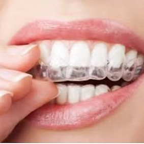 Person inserting clear plastic teeth aligner into mouth.
