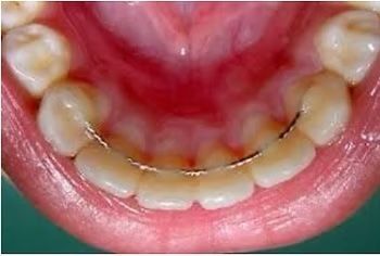 Inside view of the lower teeth with a wire retainer.