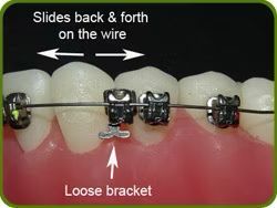 Teeth with braces; a loose bracket slides back and forth on the wire.