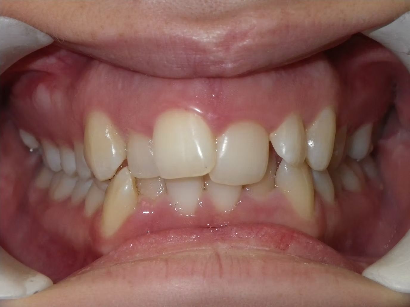 Close-up of a person's mouth showing teeth with some misalignment.
