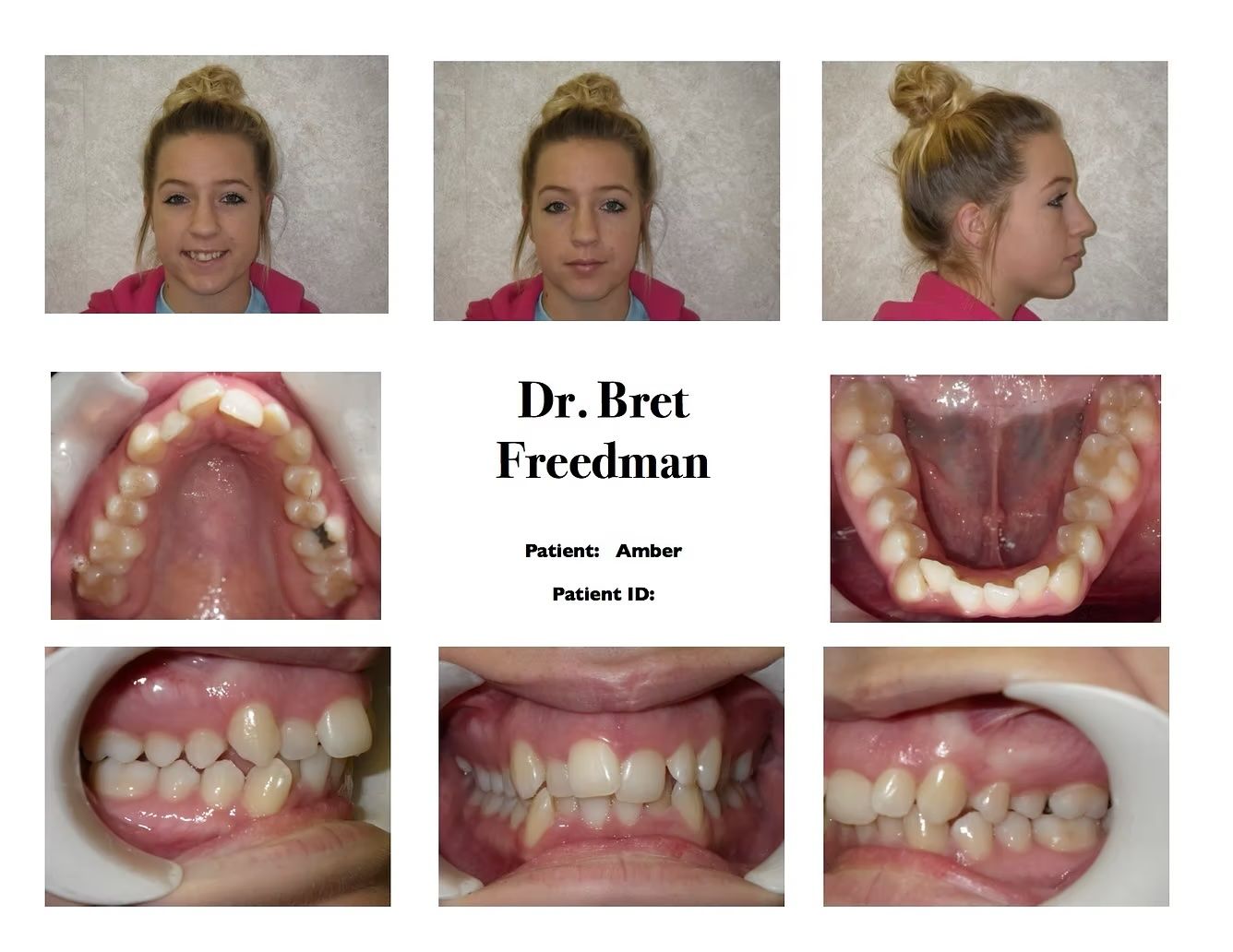 Orthodontic patient's dental exam. Front, side, and mouth views displaying overbite and crowding before treatment.