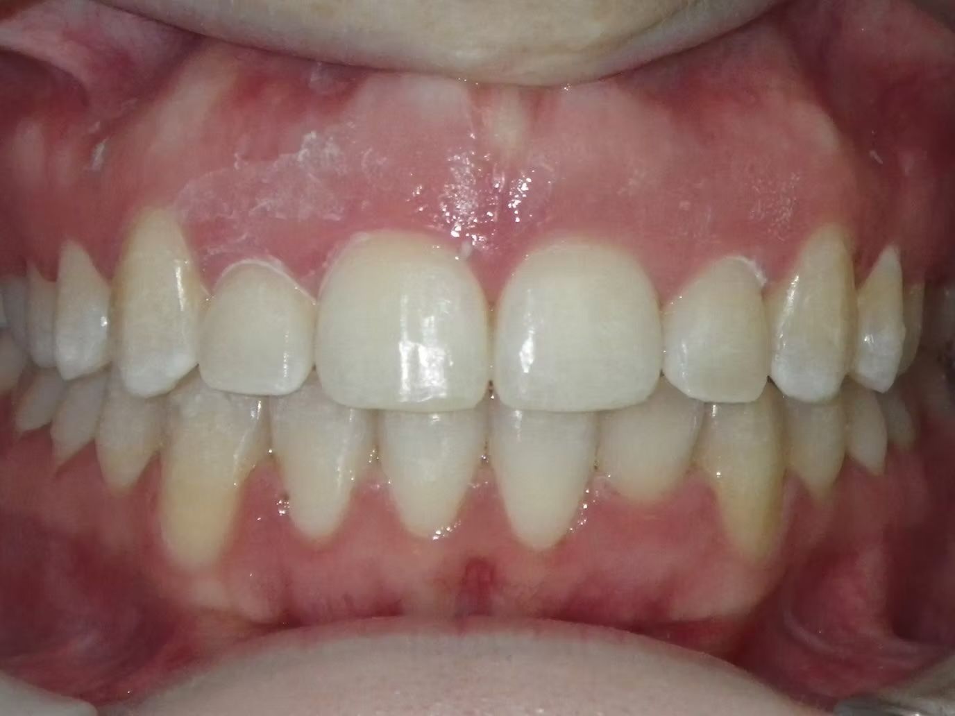 Close-up of a person's teeth. White teeth, pink gums, visible upper and lower teeth rows.