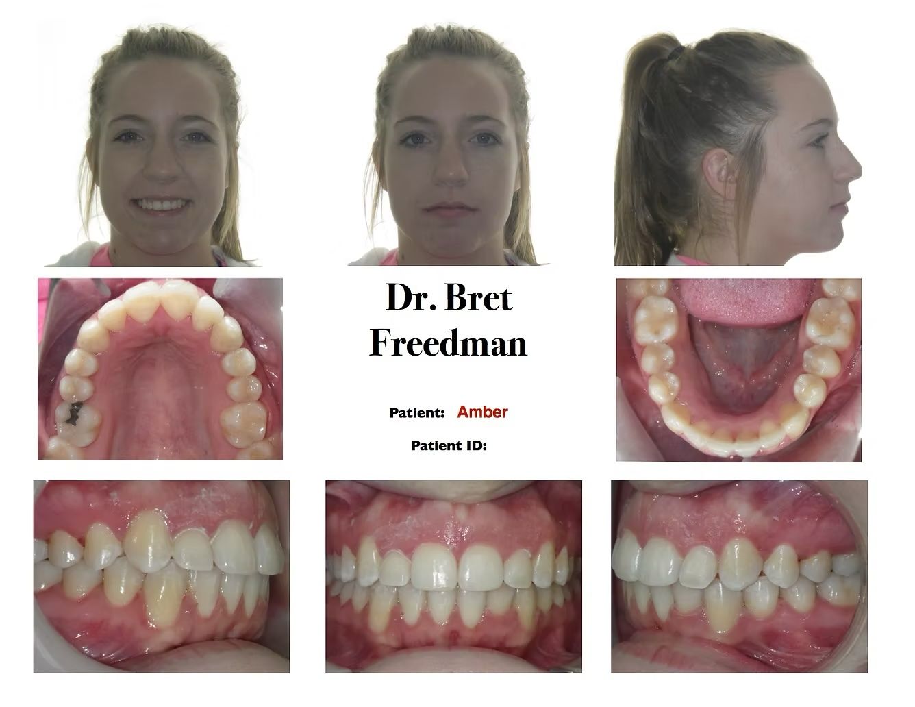 Orthodontic before-and-after of teeth. Front, profile, and dental views. Patient is smiling.