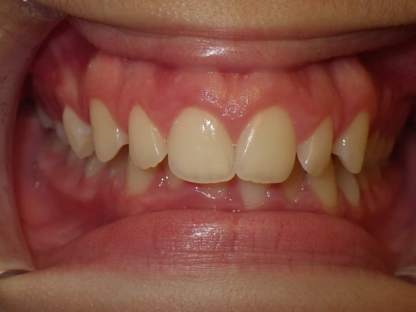 Close-up of teeth and gums showing slightly misaligned teeth and pink gums.