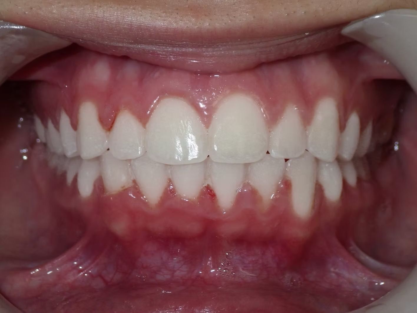 Close-up of a person's mouth with a full set of bright white teeth, pink gums, and a dental retractor in place.