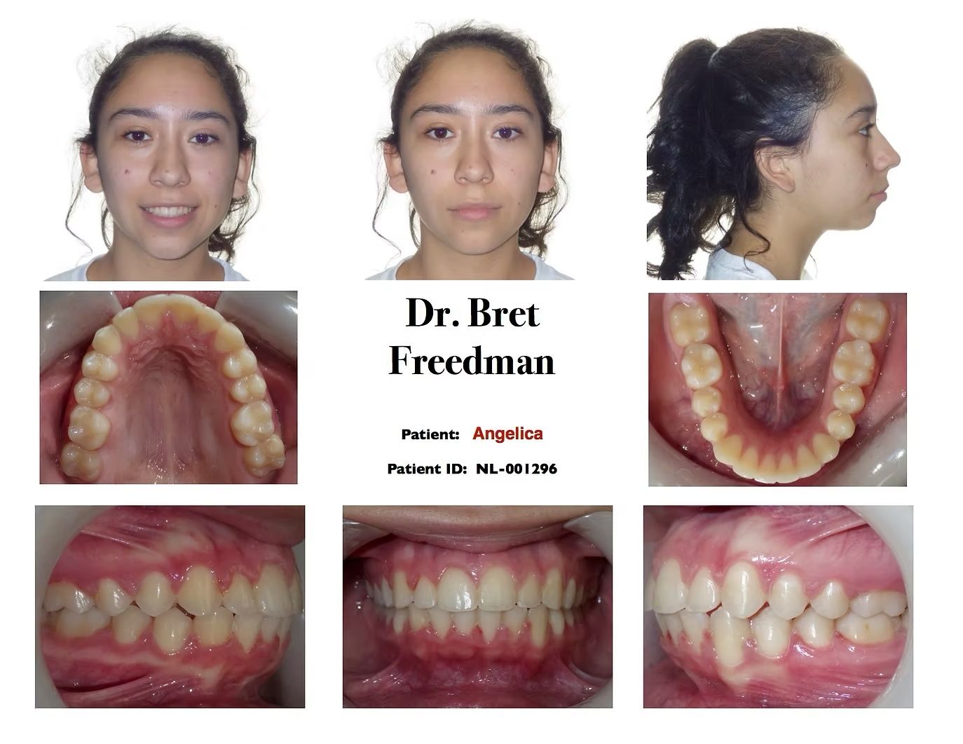 Orthodontic images showing a patient's teeth and face from different angles before treatment.