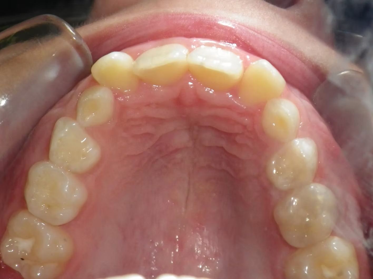 Inside-mouth view of upper teeth and palate, showing healthy, yellowish teeth and pink tissue.