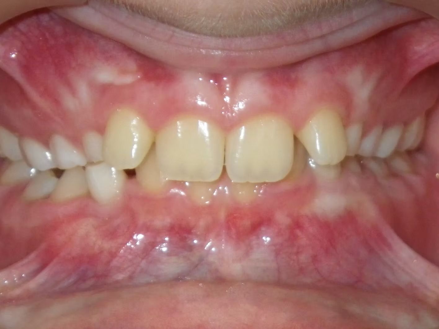 Close-up of a person's mouth with misaligned teeth; some teeth are lighter in color than others.