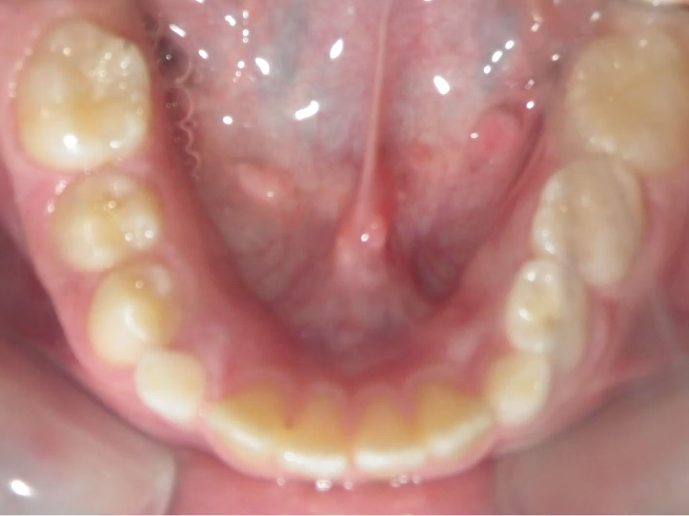 View of the lower teeth and tongue inside the mouth. The teeth are visible, along with the fleshy tongue.