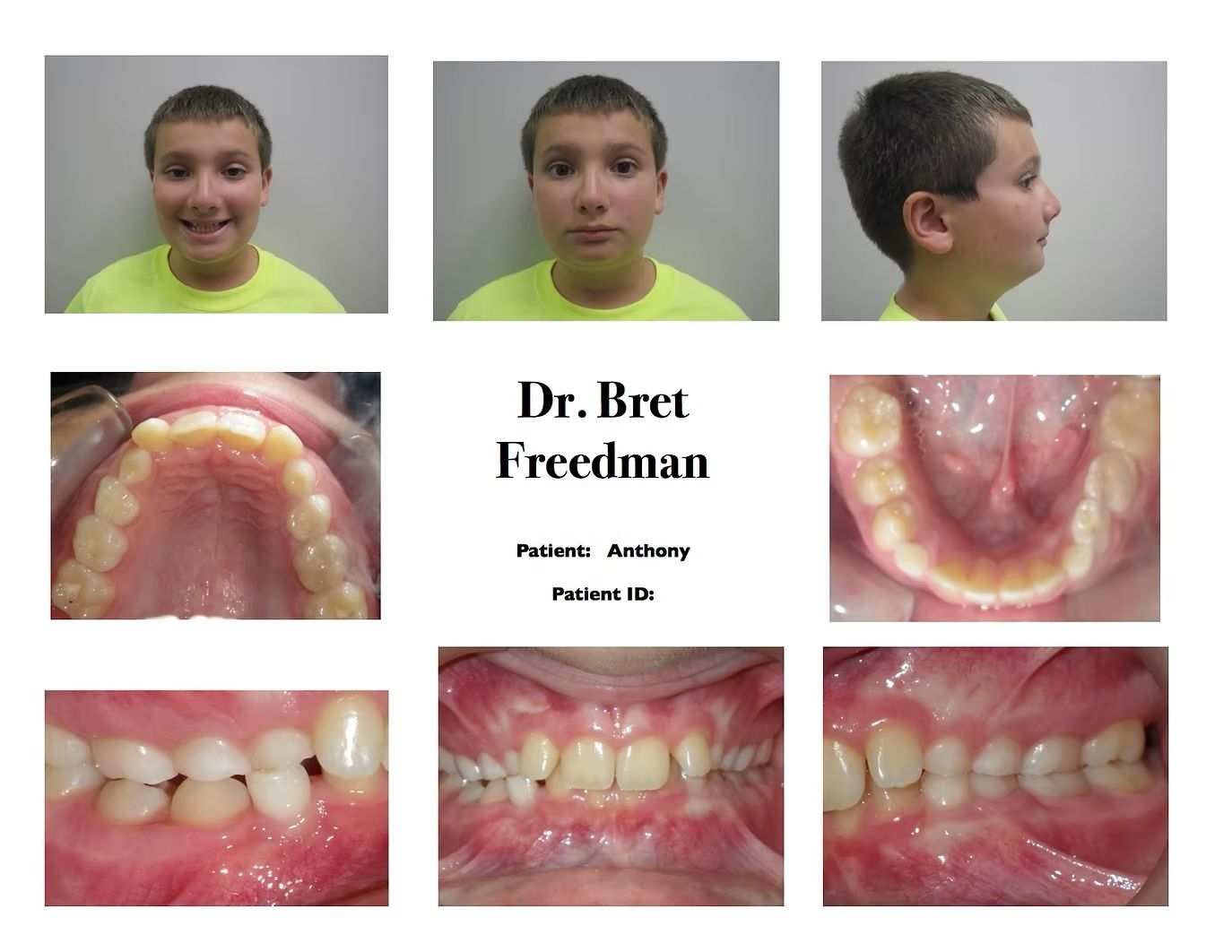 Orthodontic patient photos with dental views, smiling boy, teeth.