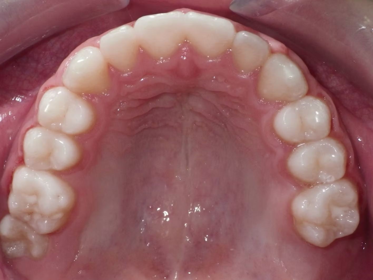 Upper view of a person's teeth, showing the palate and arrangement of molars, premolars, and incisors.