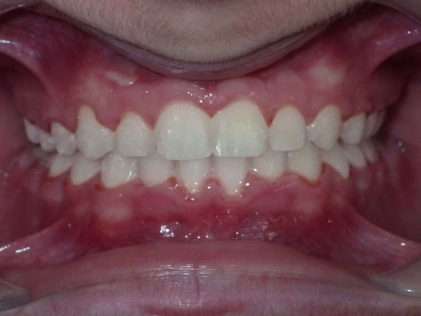 Close-up of human teeth, white with healthy pink gums, inside the mouth.