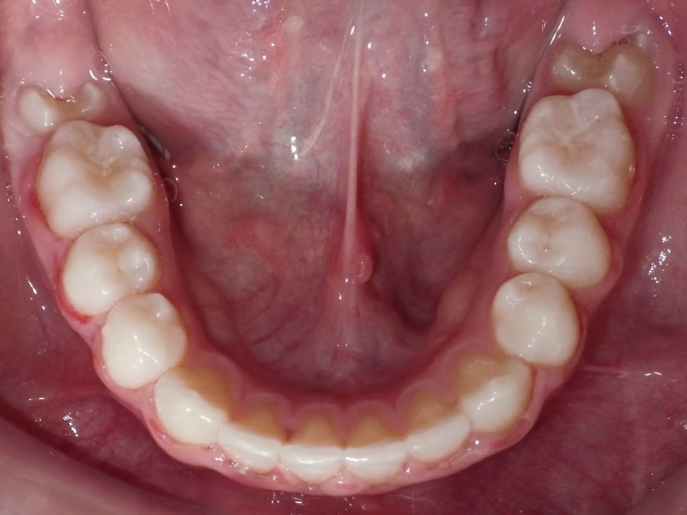 Mouth with lower teeth visible, showing healthy gums and white teeth. The tongue and palate are also visible.