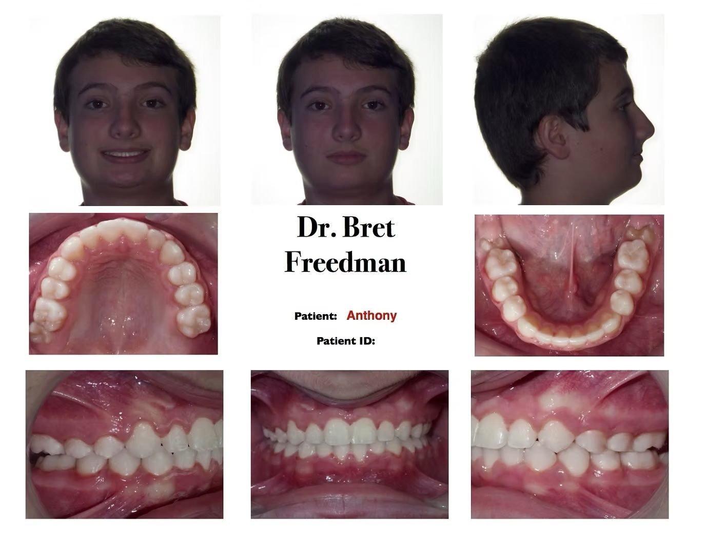 Orthodontic patient photos: facial and dental views, Dr. Bret Freedman.