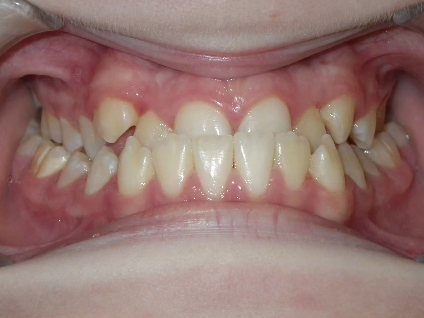 Mouth with uneven teeth; some overlapping. Gums are pink, teeth are white.