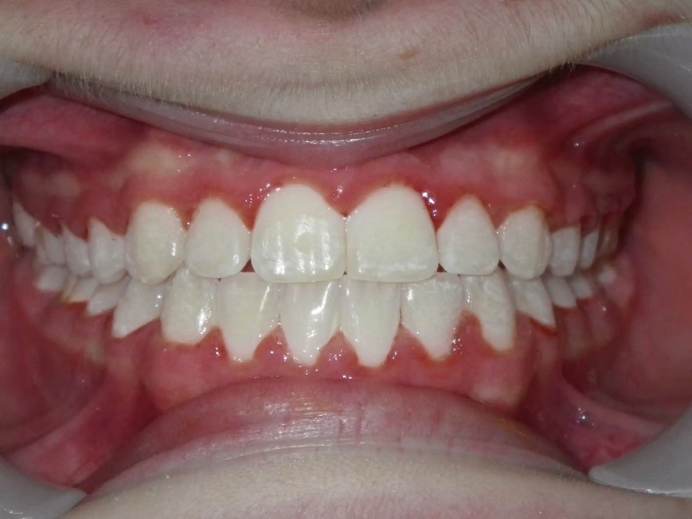 Close-up view of a person's teeth, showing a straight and white smile.