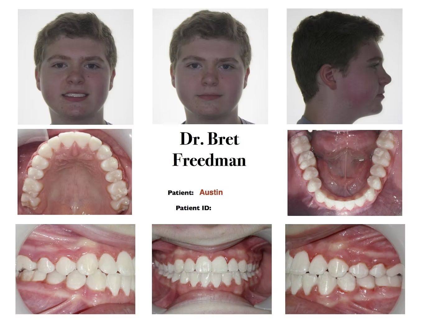 Orthodontic patient's before photos, showing face and teeth. Includes frontal, profile, and dental arch views.