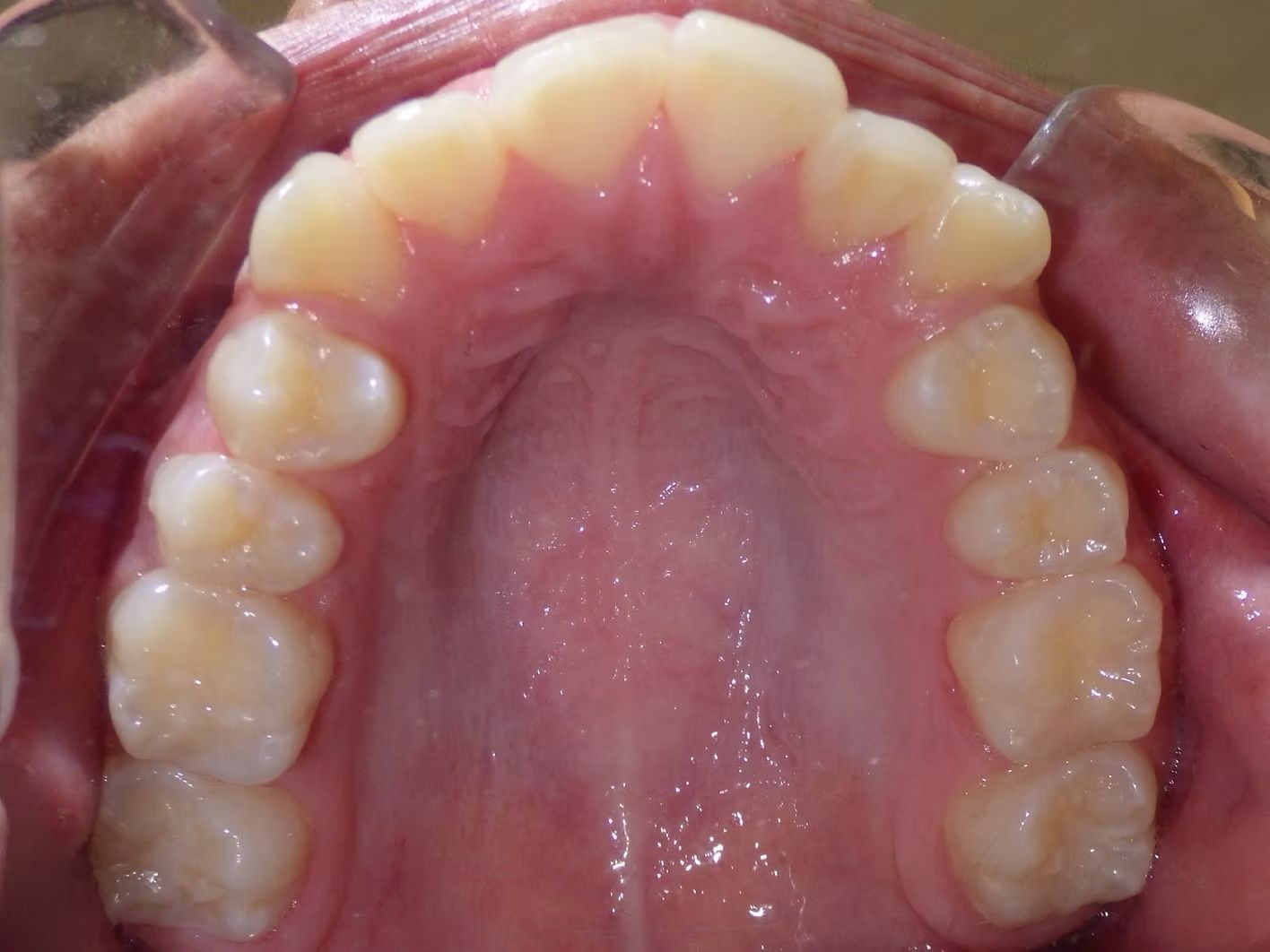 Close-up of a person's upper teeth and palate, showing healthy, pale teeth and pink gums.