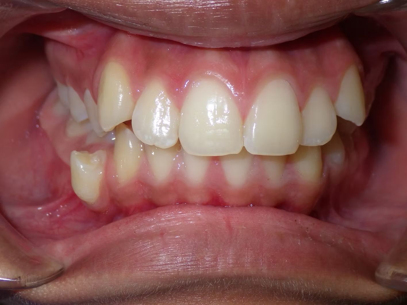 Close-up of teeth, showing an overbite and crowding. Gums are pink, teeth are light.
