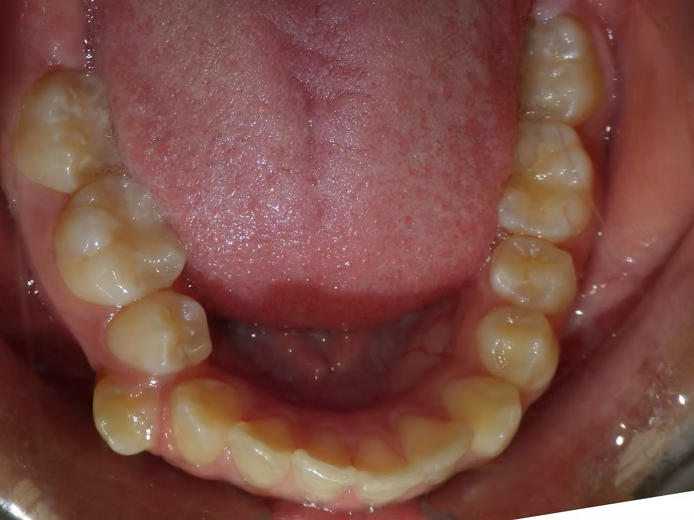 Close-up of the upper teeth in an open mouth, showing healthy, yellowish molars and incisors.