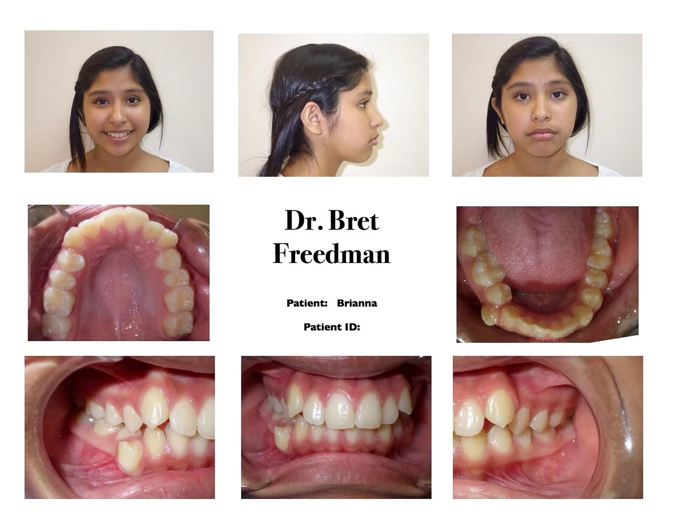 Orthodontic patient photos: facial and intraoral views, showing teeth and bite details.
