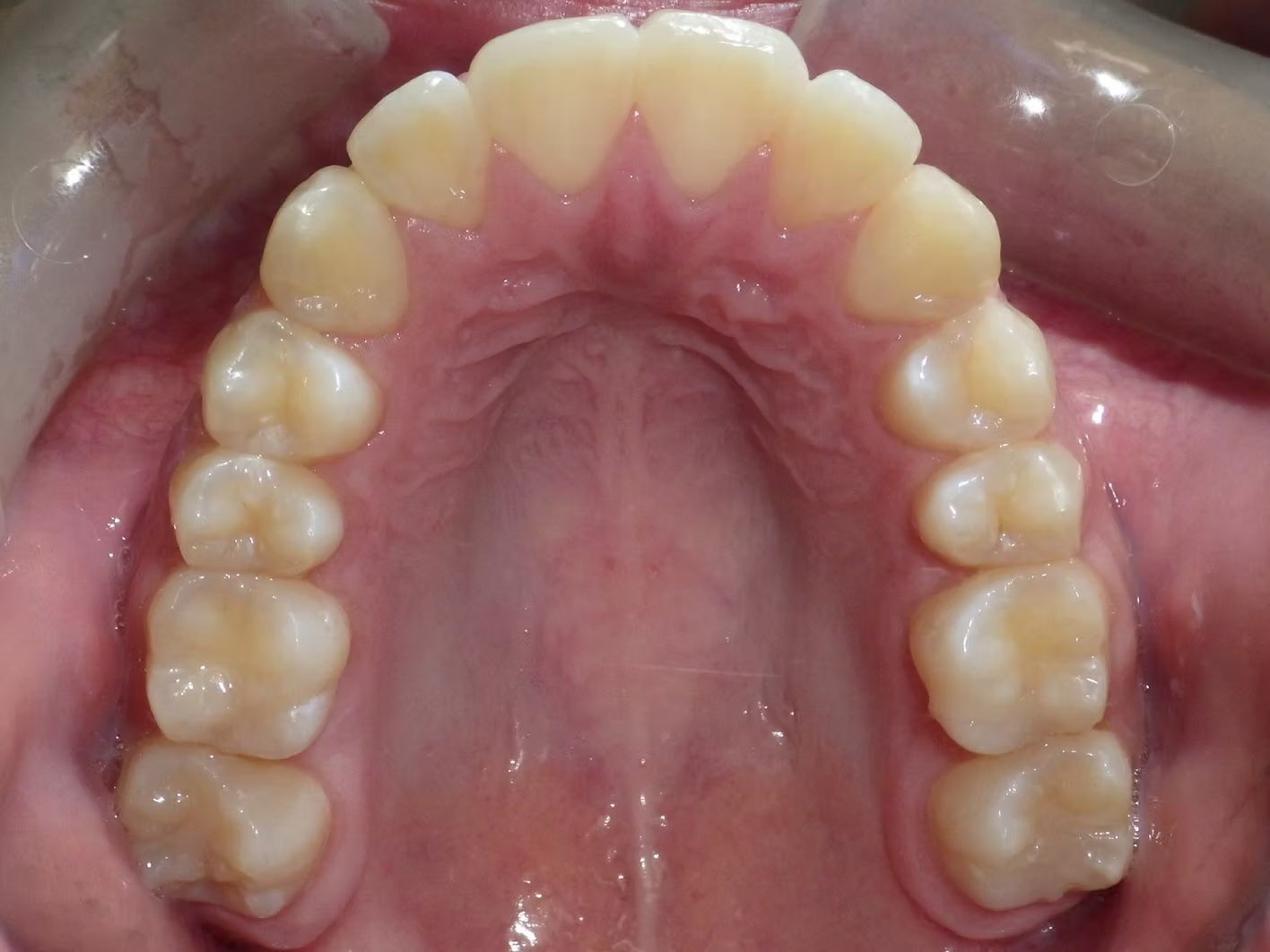 Upper dental arch, showing light yellow teeth and pink gums, viewed from inside the mouth.