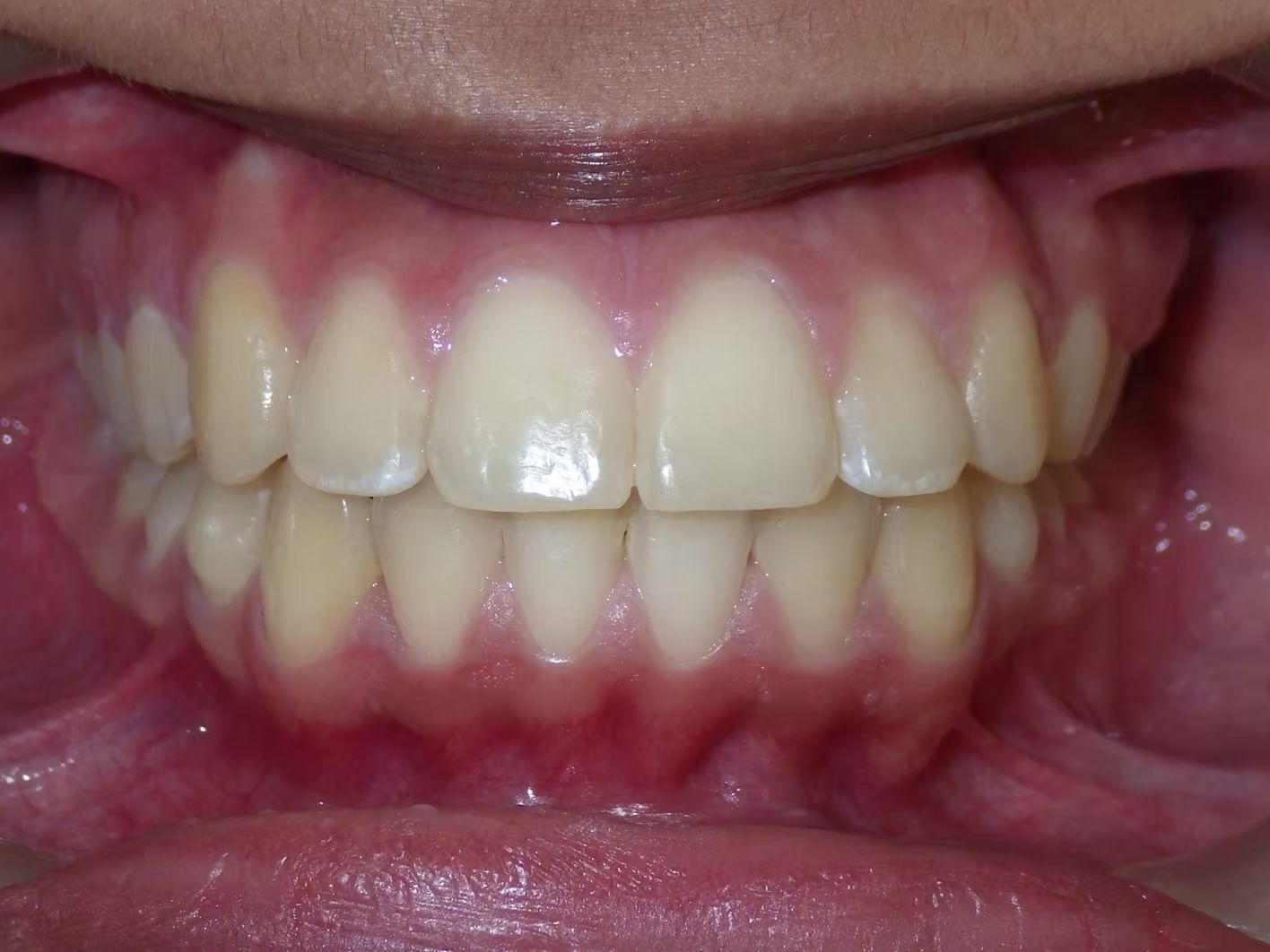 Close-up of a person's teeth. White teeth, pink gums, visible upper and lower teeth rows.