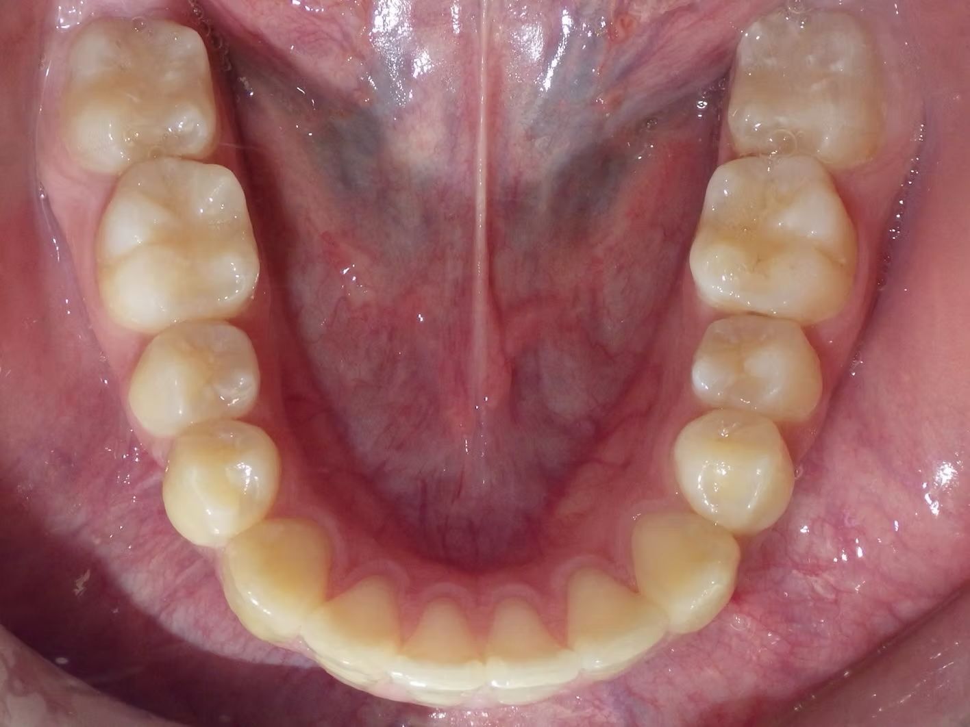 Interior view of a mouth showing lower and upper teeth; tongue visible in the center.