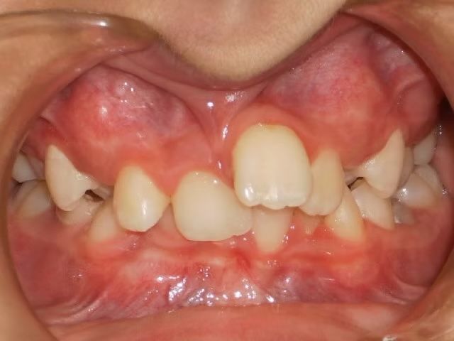 Close-up of a person's mouth with misaligned teeth and pink gums.