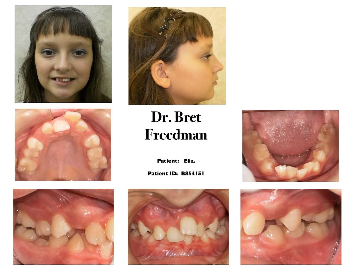 Orthodontic assessment: Front and side facial views and intraoral photos of a patient's teeth before treatment.
