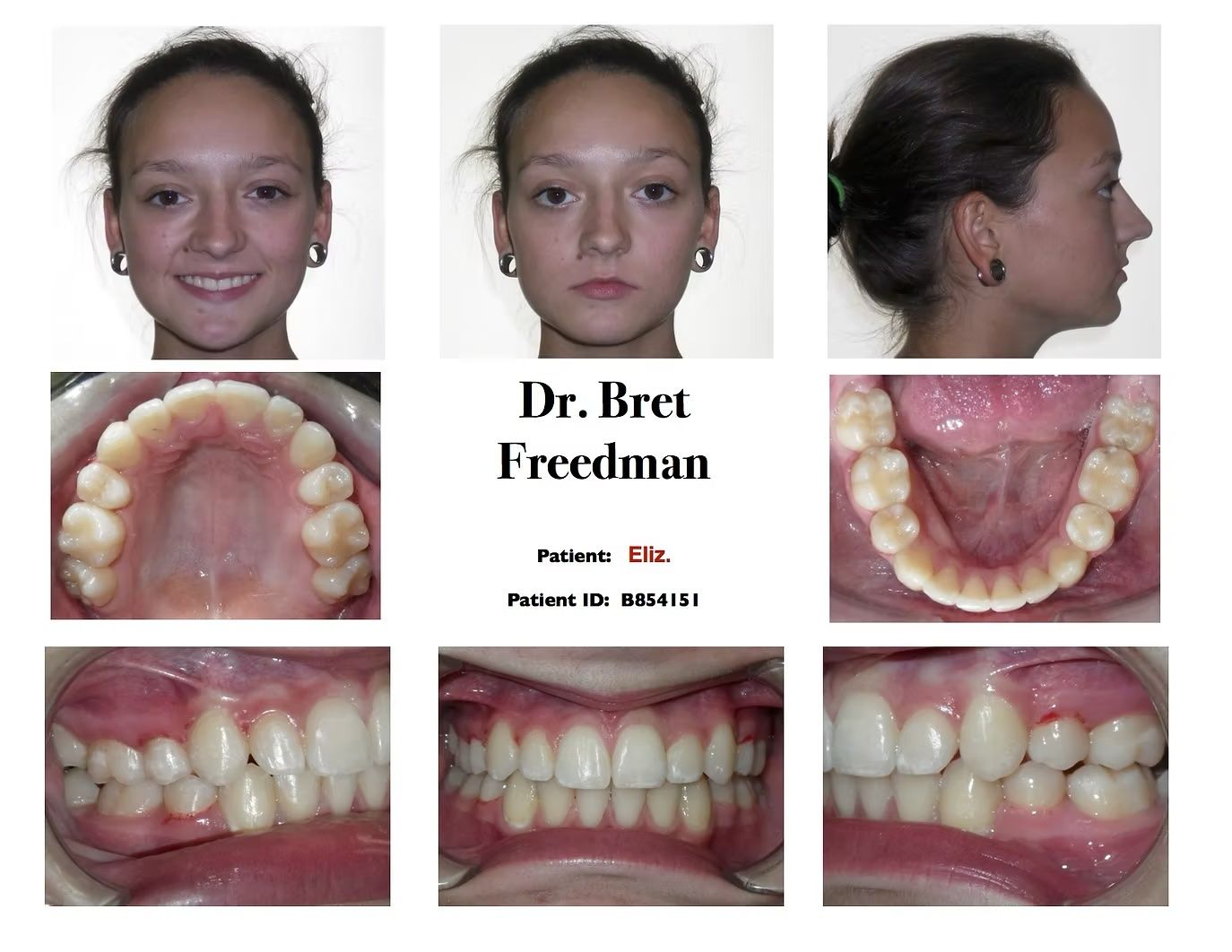 Orthodontic patient's face and teeth before treatment, with Dr. Bret Freedman's logo.