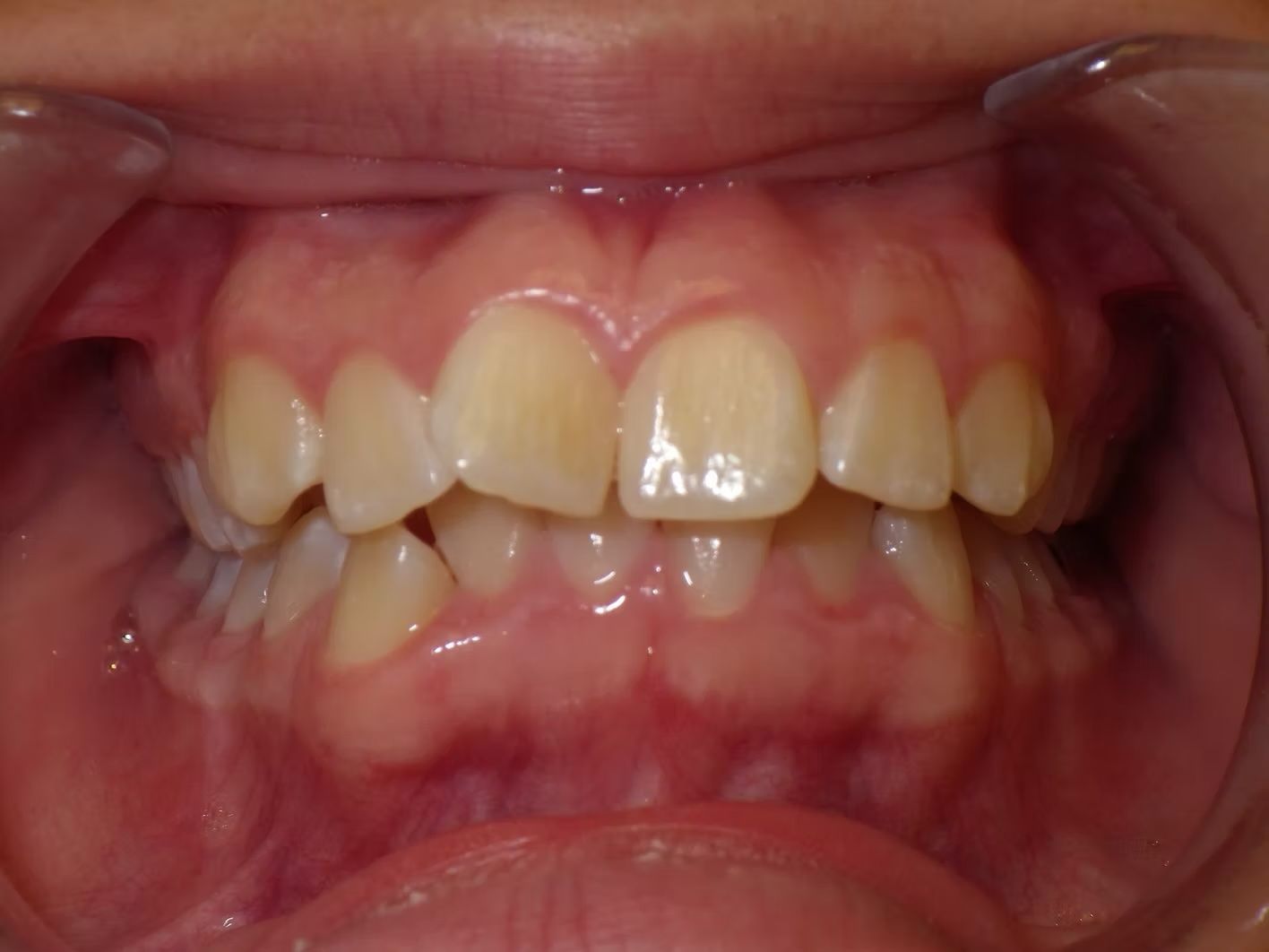 Close-up view of a person's teeth, showing crowding and misalignment, against pink gums.