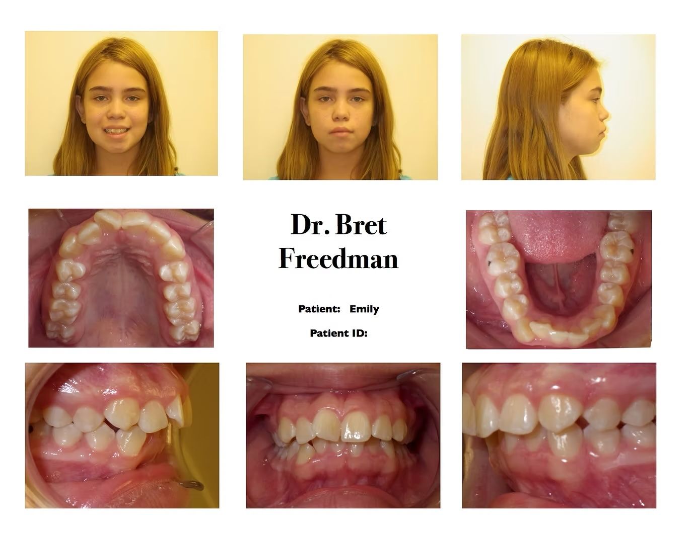 Orthodontic patient's dental records, including facial and intraoral views, for diagnosis by Dr. Bret Freedman.