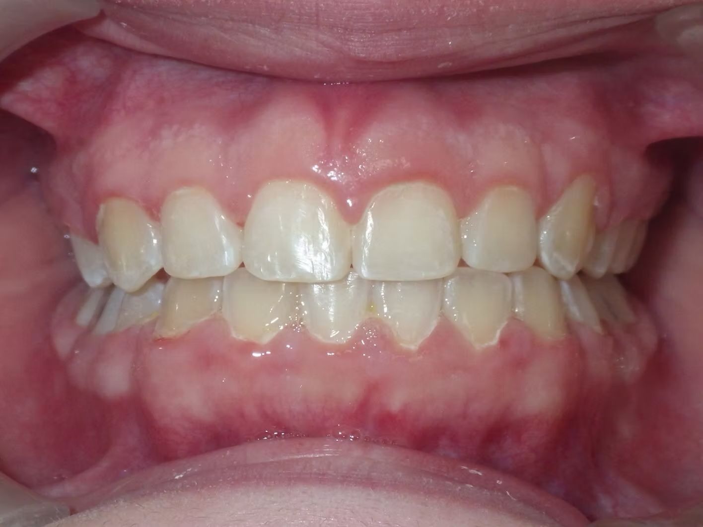 Close-up of a person's teeth, showing slight yellowing and normal alignment. Pink gums surround the teeth.