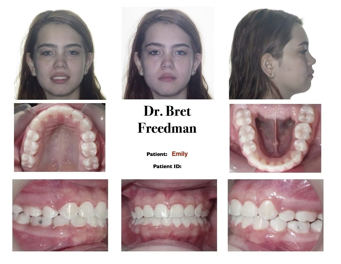 Orthodontic patient Emily's before treatment photos. Front, profile, and intraoral views of teeth.