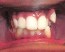 Close-up of teeth in the mouth. One tooth is rotated. A small wire is visible.