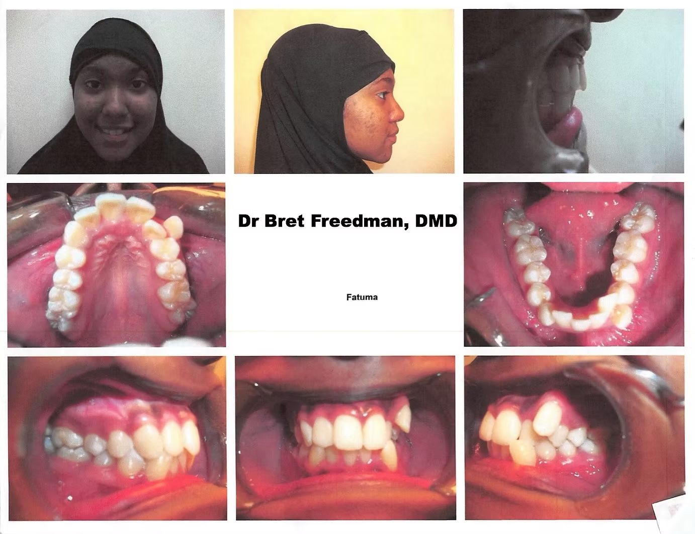 Orthodontic images showing a patient's face and teeth with various views.