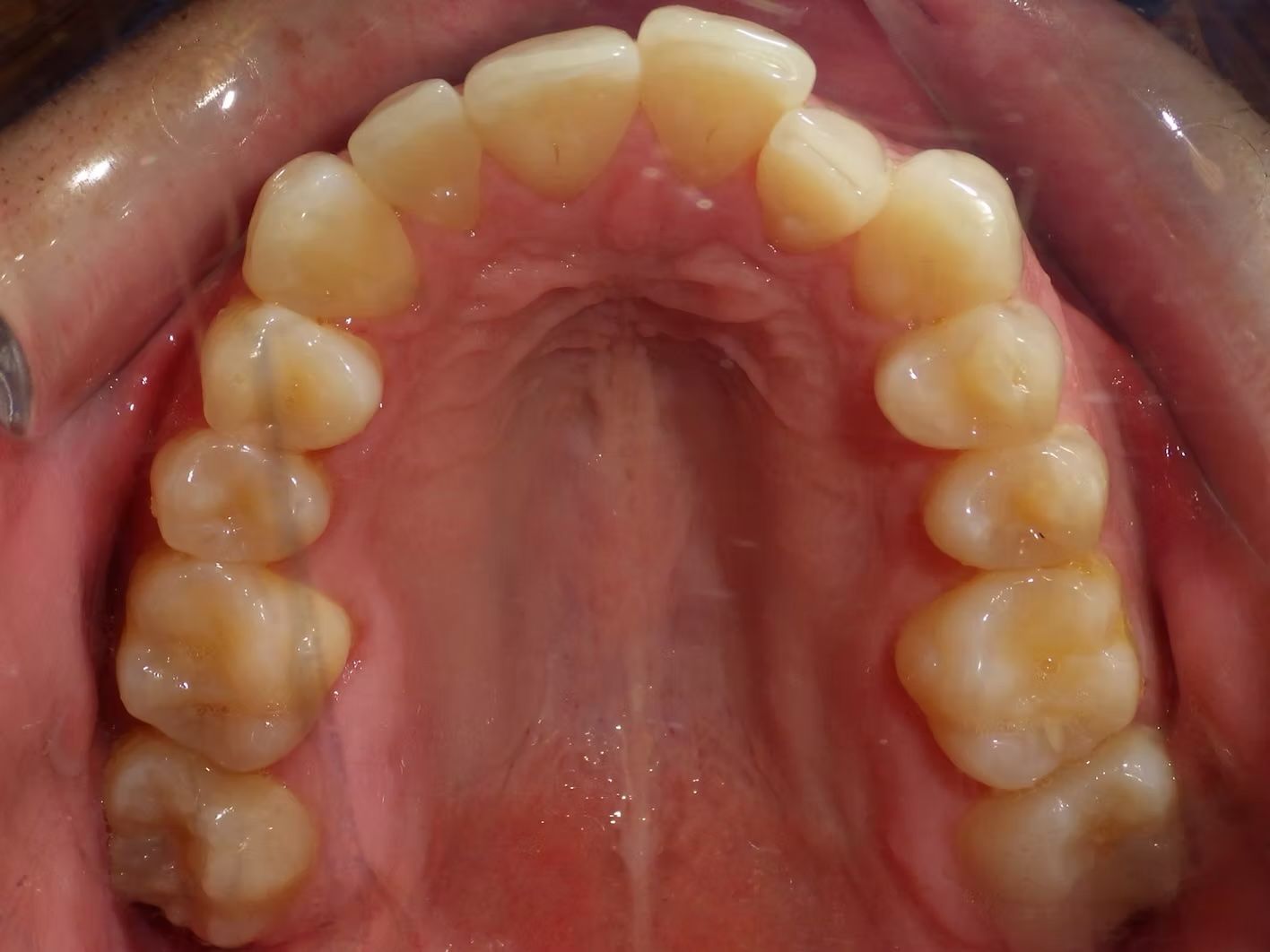 An upward view of a person's upper teeth and palate, showcasing healthy, light yellow teeth.