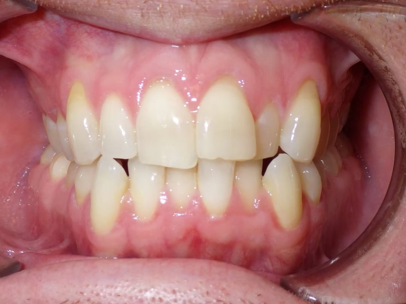 Close-up of a person's teeth, showing slight yellowing. Pink gums visible.