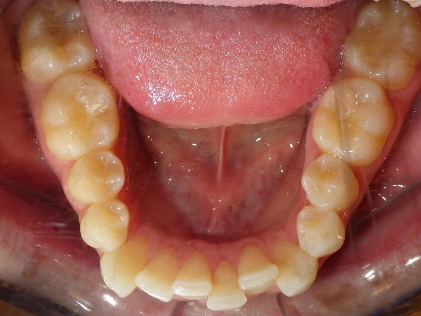 View of the lower teeth and tongue inside a mouth. The teeth are visible, and the tongue is pink.