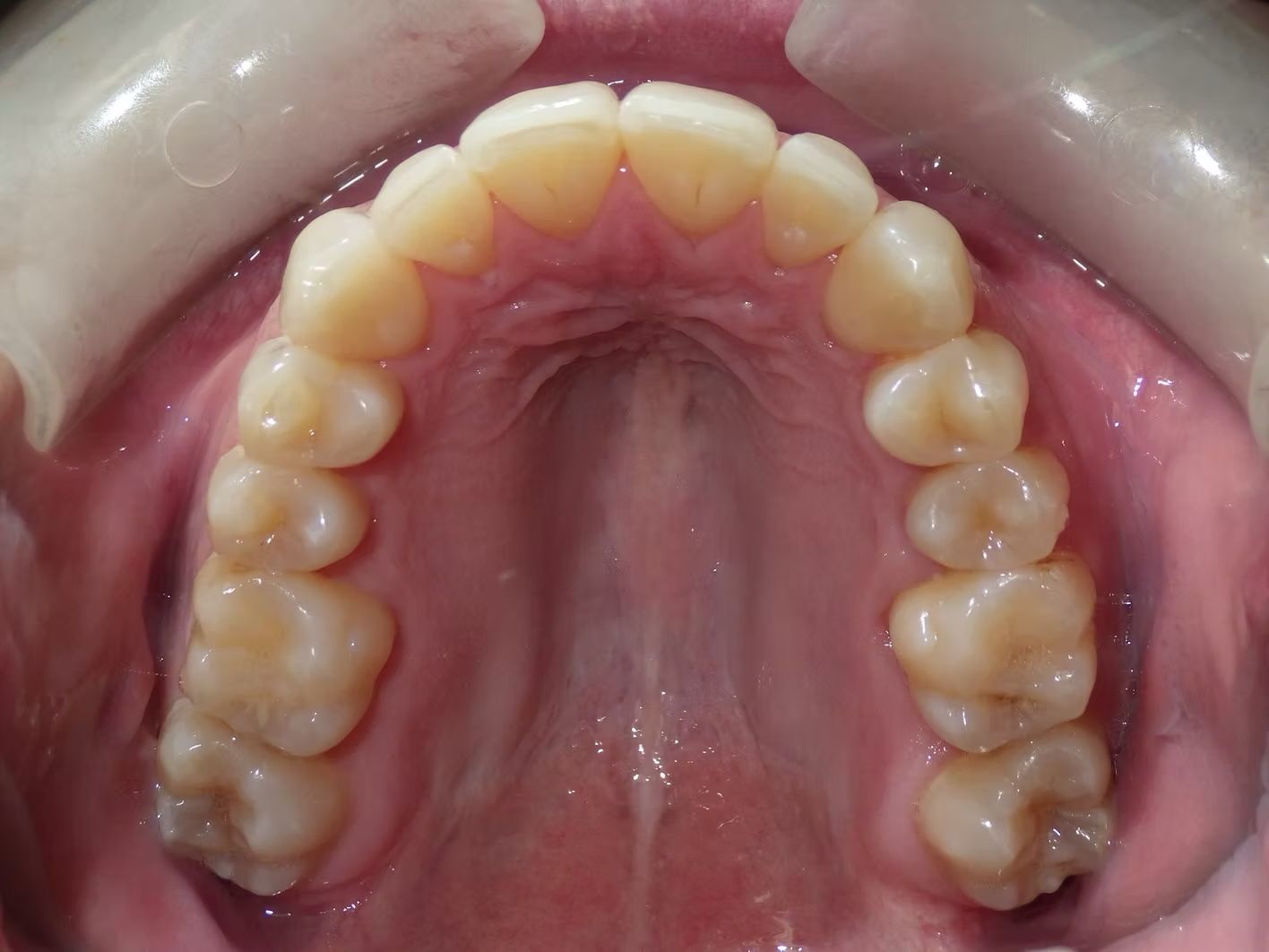 Close-up of a person's teeth, showing the upper and lower teeth. They are white with pink gums.