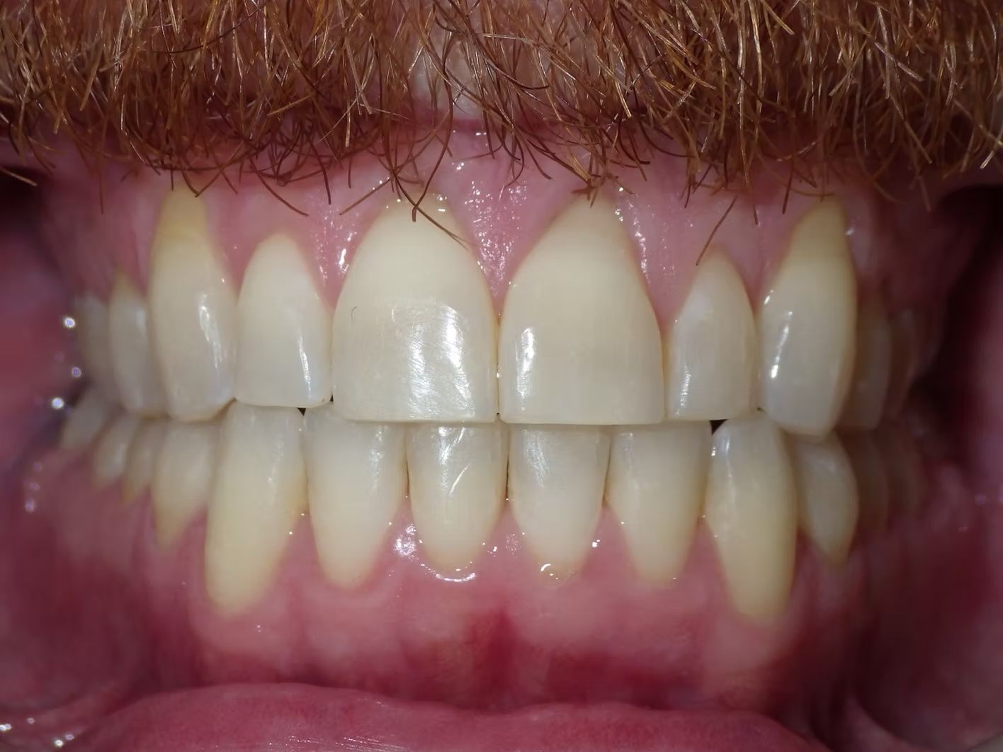 Orthodontic patient photos: face, profile, upper/lower teeth views.