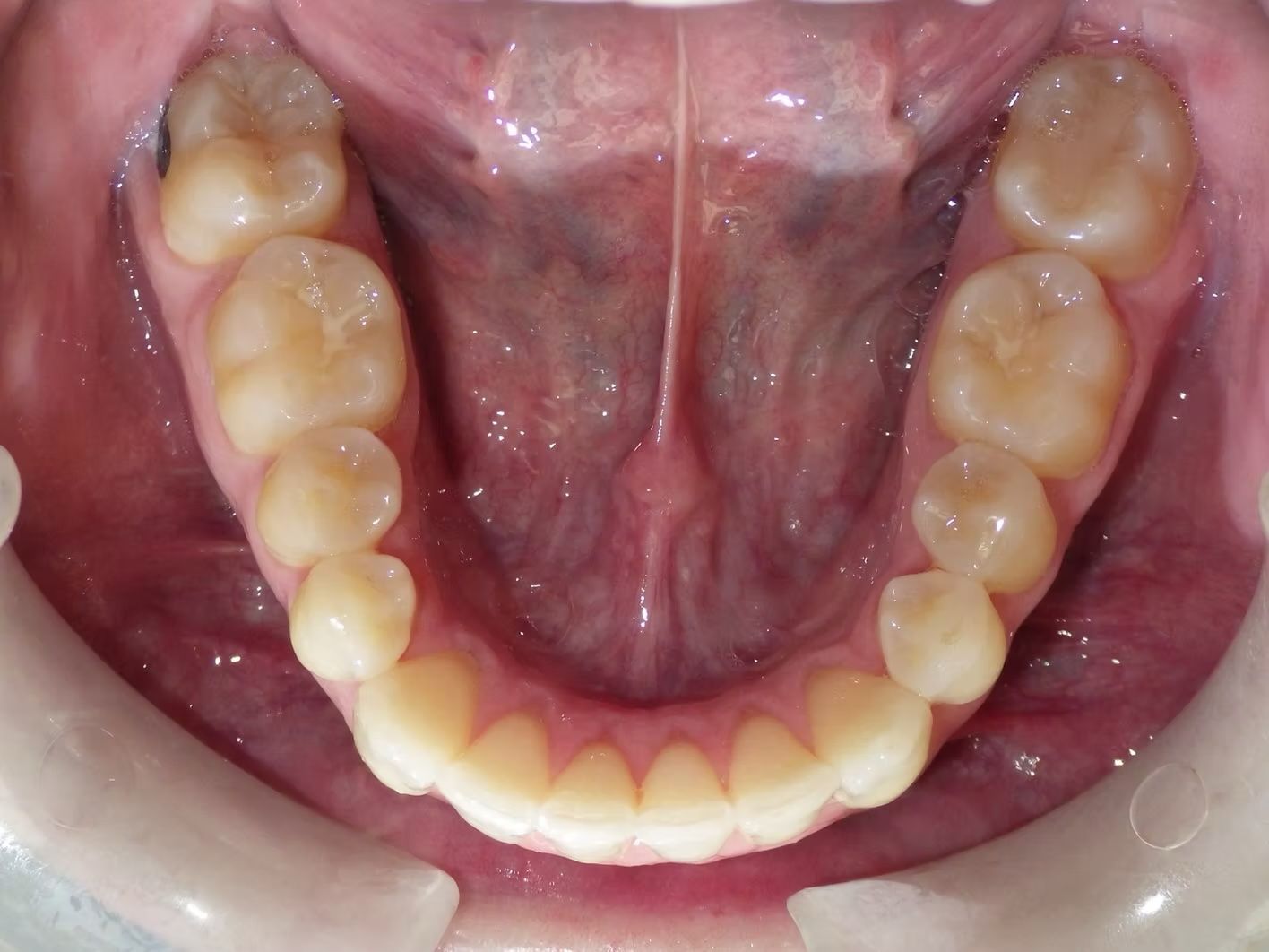 Close-up of a person's upper teeth and palate, showing healthy teeth in an arch shape, mouth open.