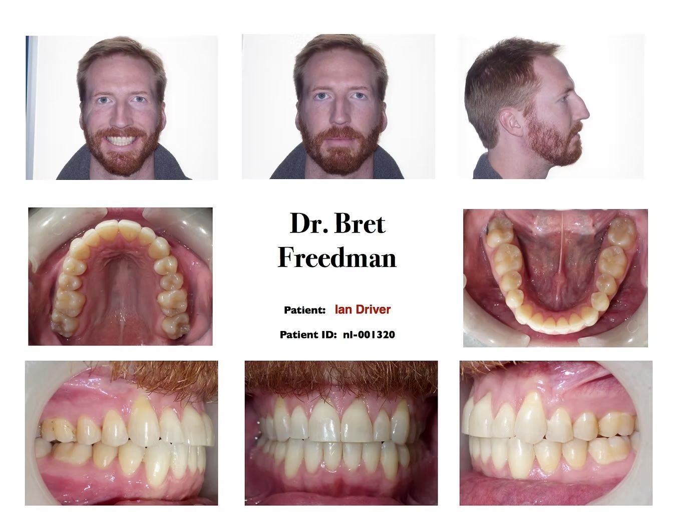 Dentist's before treatment photos: face, mouth interior, and teeth close-ups. Caucasian man smiling.